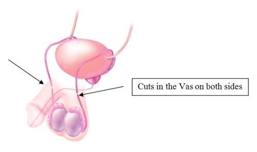 Vasectomy